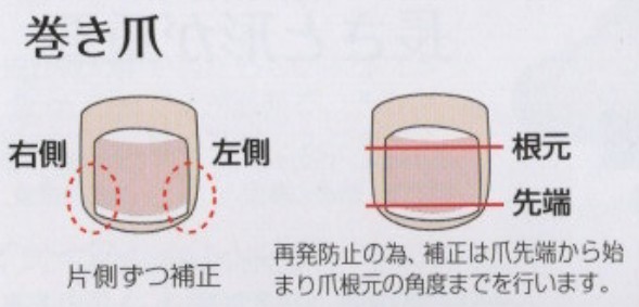 巻き爪矯正