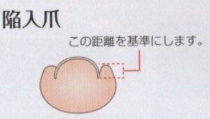 陥入爪